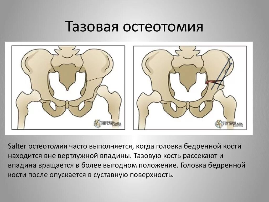 Остеотомия таза по Солтеру. Остеотомия таза по Salter. Расхождение костей таза.