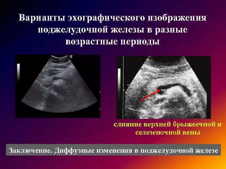 Диффузное изменение поджелудочной неспецифического характера. Паренхима-УЗИ поджелудочной железы. Эхографические изменения поджелудочной железы. Диффузные изменения поджелудочной железы на УЗИ. Диффузные изменения паренхимы поджелудочной.