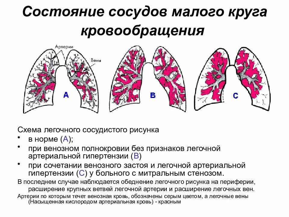 Нарушение кровообращения малого круга. Венозный застой в Малом круге. Венозный застой рентген признаки. Застой малого круга кровообращения в легких. Венозный застой в Малом круге кровообращения.