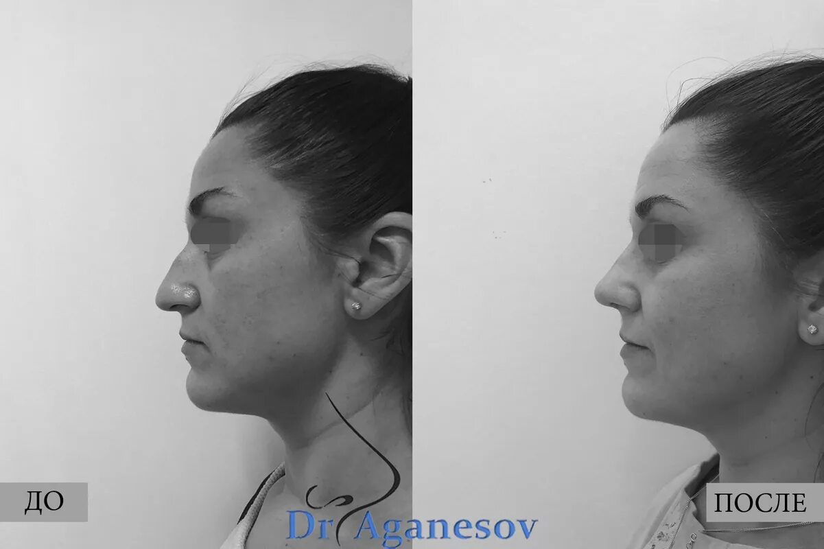 У человека нос с горбинкой доминантный. Менлелирущие признауиу человеуа. У человека нос с горбинкой доминантный признак. Гришкян фото операции риносептопластика. У человека нос с горбинкой доминантный.