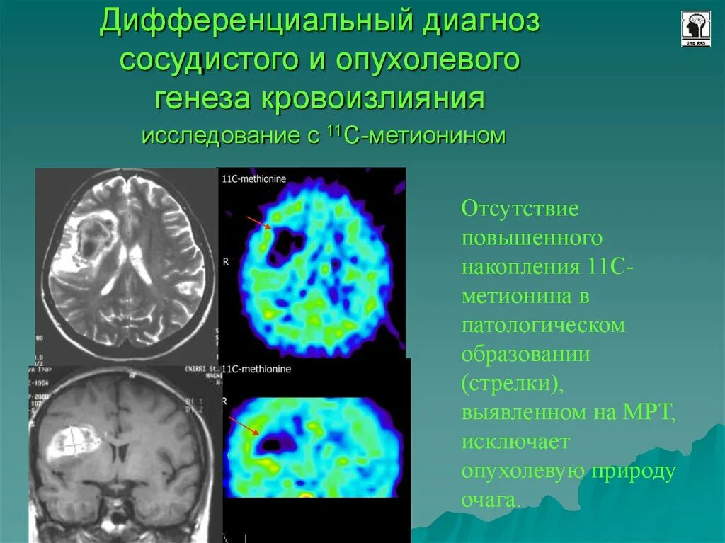 Неопластический процесс что это означает. Позитронно-эмиссионная томография головного мозга. ПЭТ головного мозга. ПЭТ К-Т головного мозга. Позитронно эмиссионная томография с метионином.