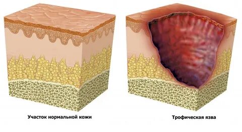 На ноге появилась появились язвы
