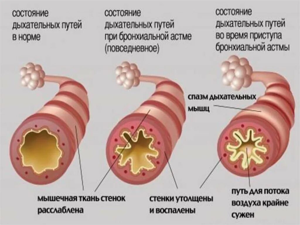 Бронхиальная астма легкий приступ