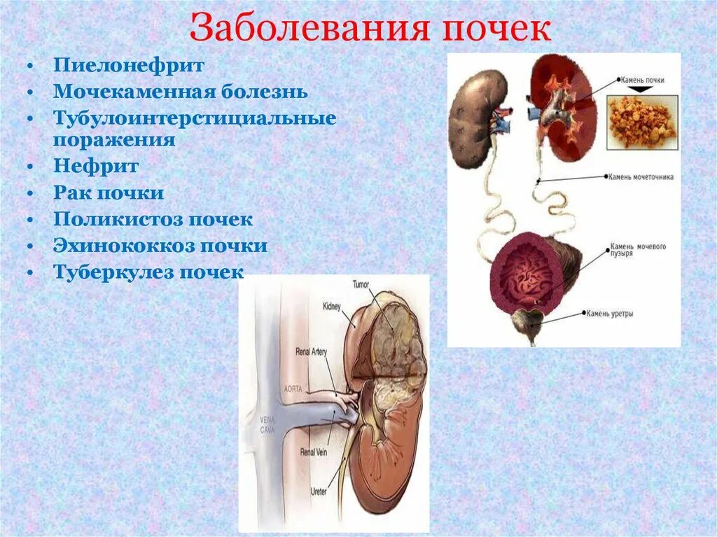 Заболевание мочевыделительной системы биология 8