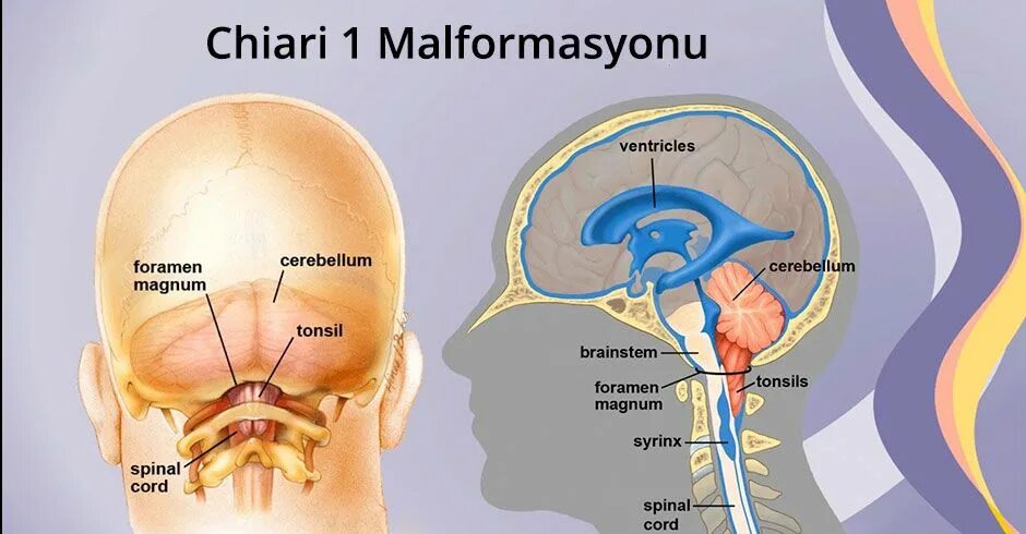 Аномалия киари степени. Платибазия Киари. Аномалия Арнольда-Киари 1 операция. Мальформация Киари 1 типа.