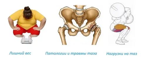 Щелкает тазобедренный сустав при поднятии