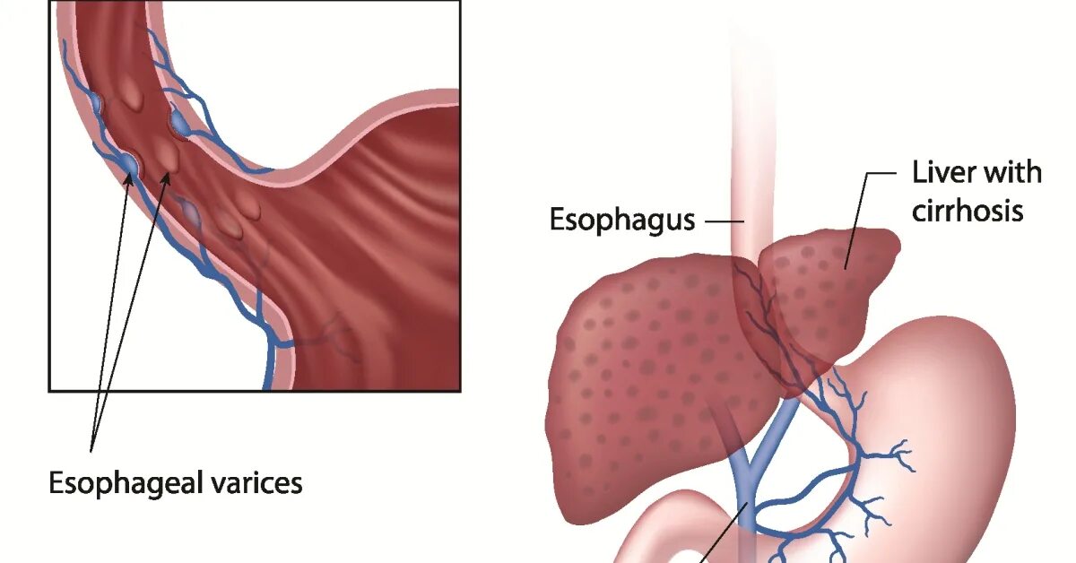Кровотечения пищевода печени
