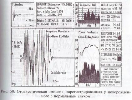 Отоакустическая эмиссия