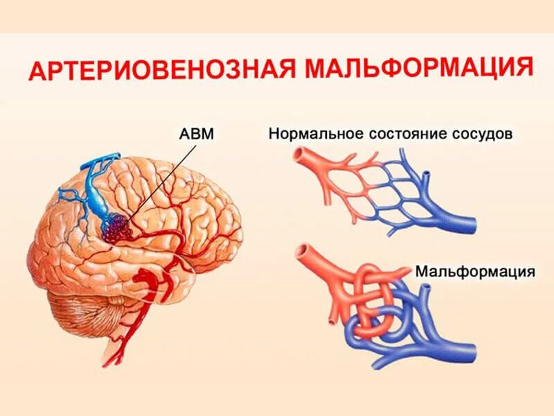 Сосудистая аномалия. Мальформация сосудов мозга. Артериально венозная мальформация. Артериовенозная мальформация сосудов головного. АВМ мальформация сосудов головного мозга.