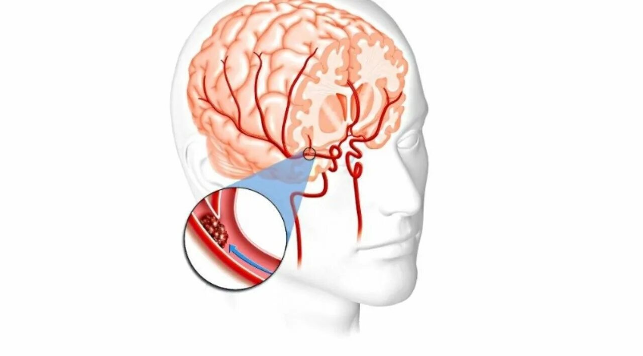 Энцефалопатия пожилых людей симптомы. Дисциркуляторная энцефалопатия синдромы. Алкогольная энцефалопатия поражение мозга. Сосудистая энцелофапатия. Алкогольная энцелофапатия головного мозга что это такое.