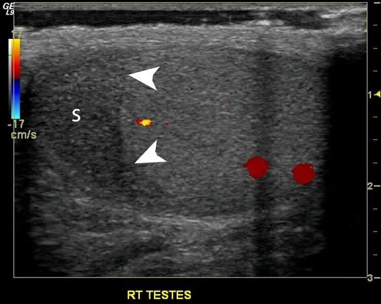 Перекрут семенного канатика на УЗИ. Перекрут левого яичка УЗИ. Семенной канатик УЗИ картина. Нормальная яичка мужчин