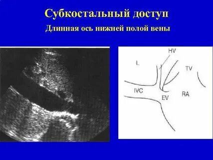 Расширение нижней