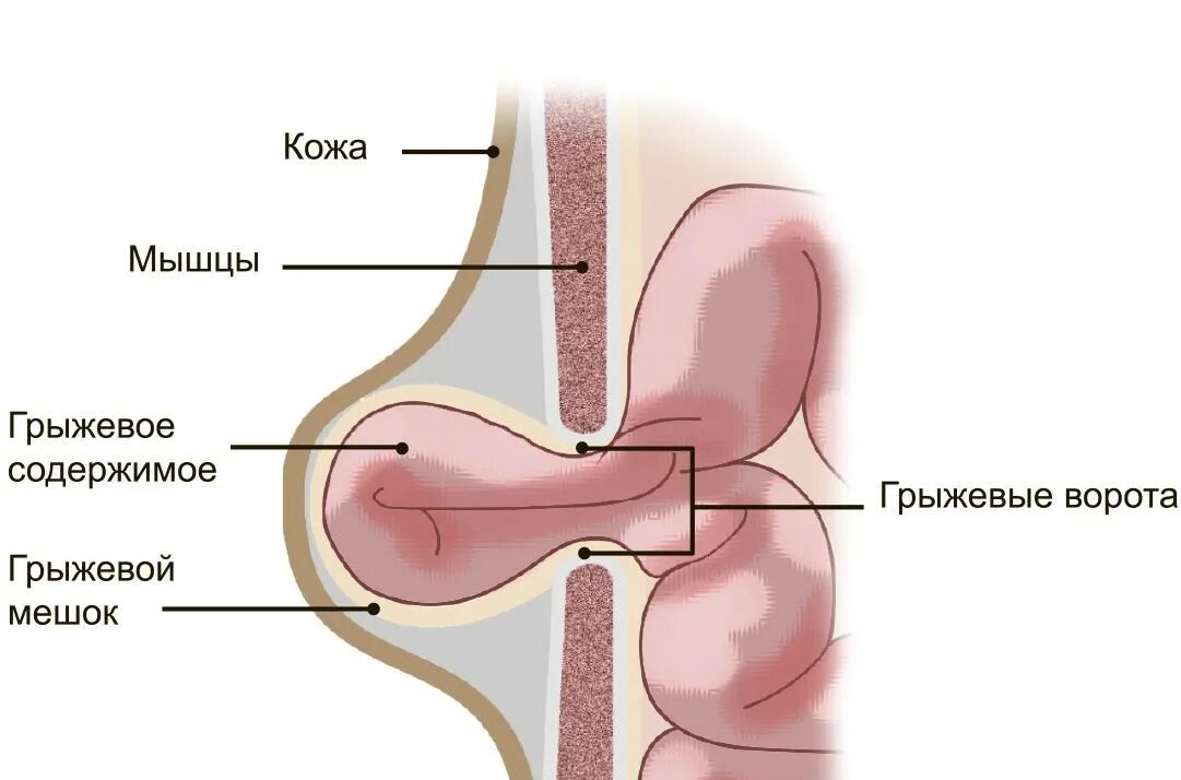 Грыжа что это такое и как. Двухсторонняя паховая двухсторонняя грыжа.