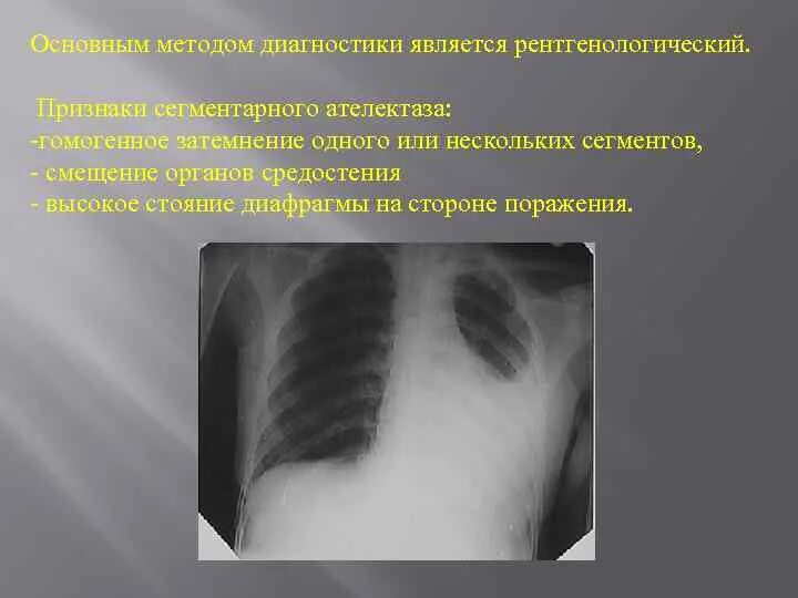 Признаки ателектаза легкого. Ателектаз доли рентген. Компрессионный ателектаз легкого. Ателектаз смещение средостения. Ателектаз нижней доли рентген.