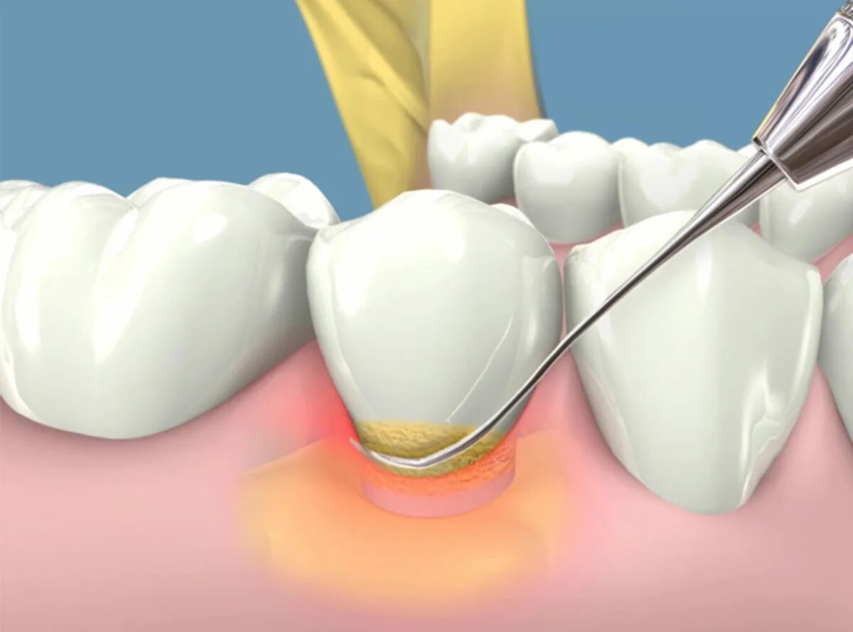 Воспаление канала зуба