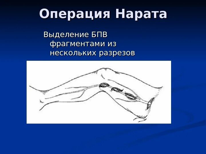 Удалить большую подкожную вену