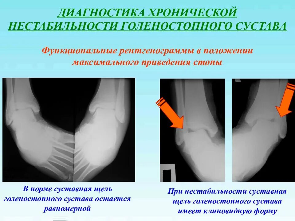 Диагноз голеностопный сустав. Нестабильность сустава голеностопа. Нестабильность голеностопного сустава рентген. Нестабильный сустав голеностопа. Нестабильность коленного сустава рентгенодиагностика.