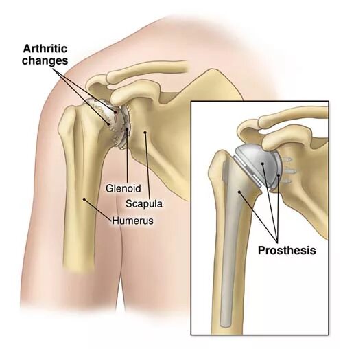 Реверсивное эндопротезирование плечевого сустава. Эндопротезирование плечевого сустава рентген. Эндопротез плечевого сустава Тотальный реверсивный. Эндопротез ревизионный плечевого сустава. Операция по замене плечевого сустава