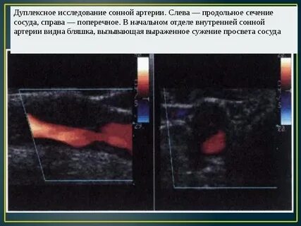 Холестериновая бляшка в сонной артерии