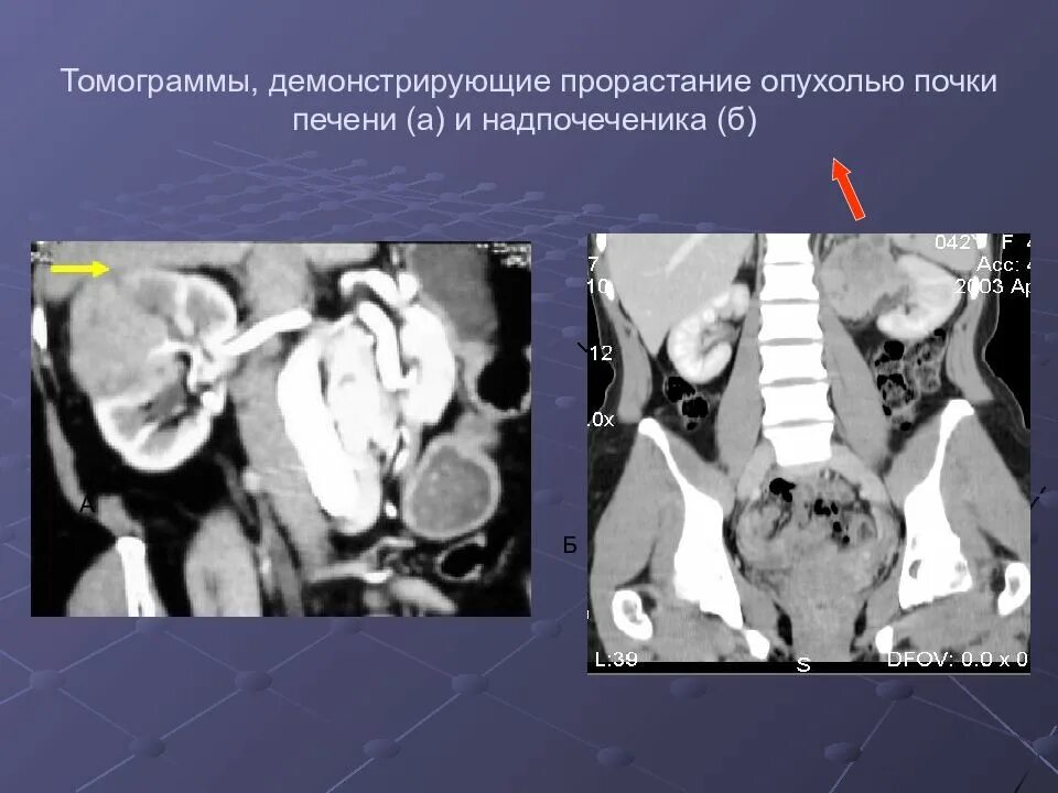 Метастазы рака почки. Прорастание опухоли в окружающие ткани. светлоклеточная карцинома почки кт.