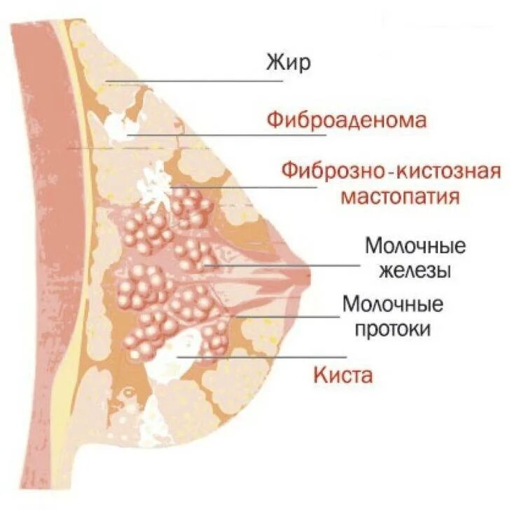 Диффузно кистозная мастопатия молочных. Жжение в молочных железах. фиброзия молочных желез. мастодиния молочной железы. фиброаденома мастопатия.