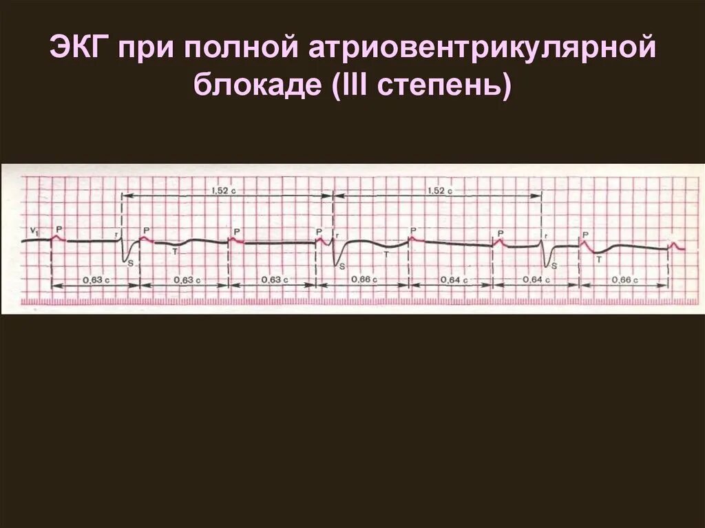 Fuller av. АВ блокада 3 степени на ЭКГ. Полная атриовентрикулярная блокада на ЭКГ. Полная АВ блокада 3 степени ЭКГ. ЭКГ при АВ блокаде 3 степени.