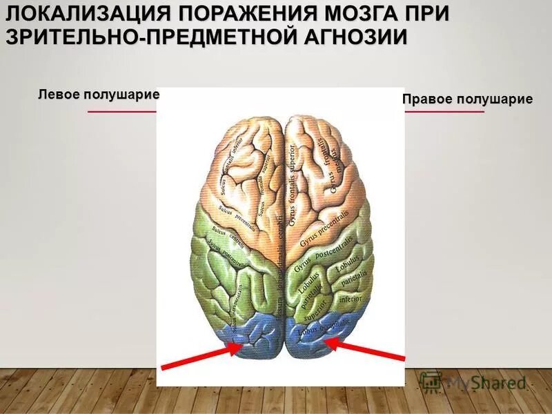 слуховая агнозия очаг поражения.