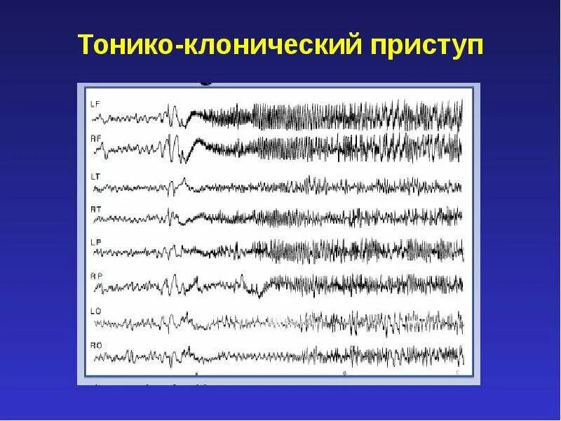 Генерализованные тонико-клонические приступы ЭЭГ. ЭЭГ тонико клонические. Тонико-клонические судороги ЭЭГ. Тонико клонические припадки