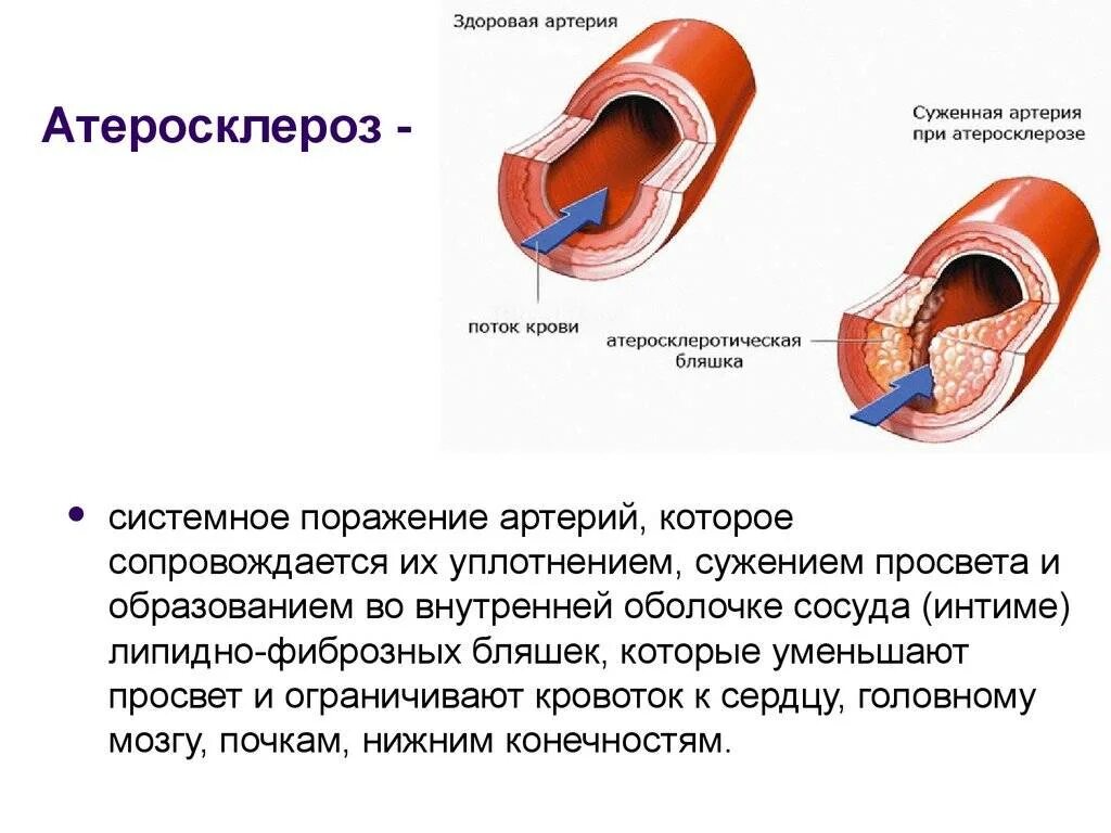 Атеросклероз стенки артерии. Атеросклеротическое поражение сосудов. Атеросклеротического поражения стенок кровеносных сосудов. Атеросклеротические изменения сосудов. Сужение сосудов симптомы лечение