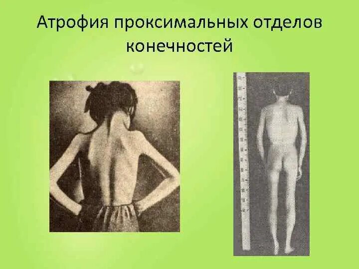 Тест с ответами проксимальная спинальная мышечная атрофия. Тест с ответами проксимальная спинальная мышечная атрофия