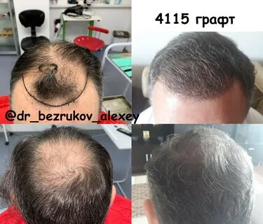 Сколько после пересадки волос