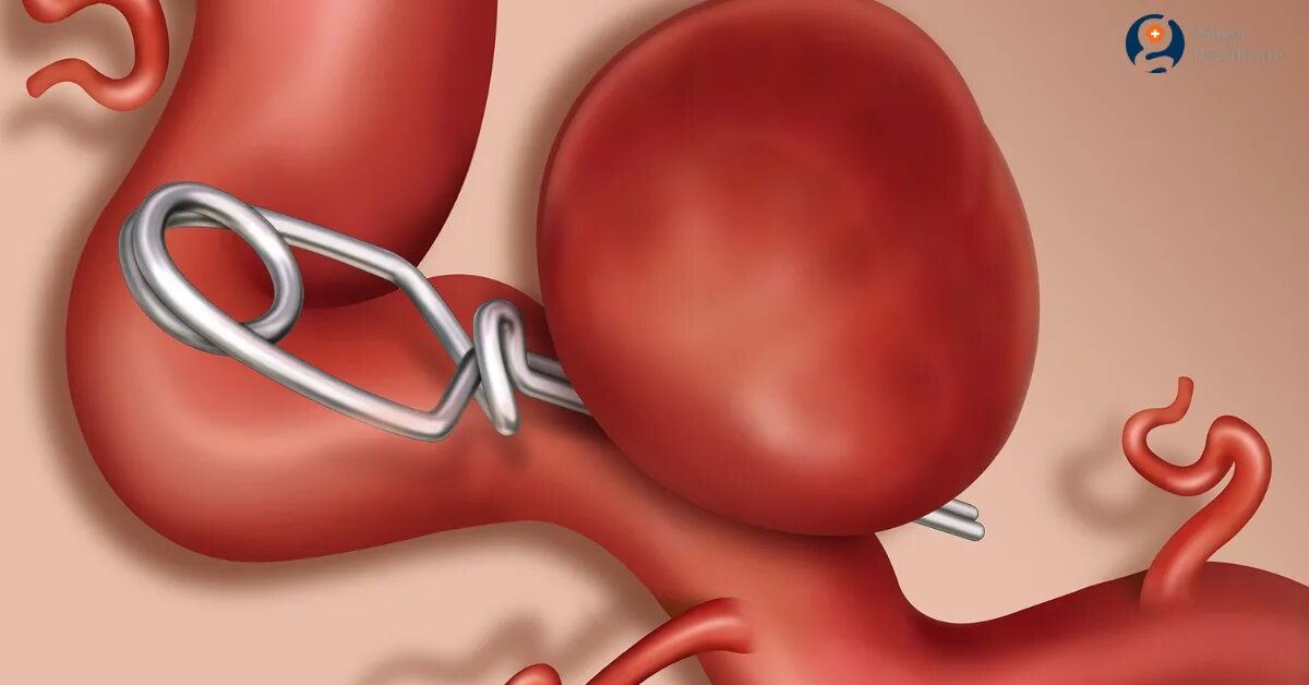 Аневризма стент. Аневризма головного мозга клипирование. Клипирование артериальных аневризм сосудов головного мозга. Клипирование мешотчатой аневризмы. Эндоваскулярная эмболизация аневризм сосудов головного мозга..