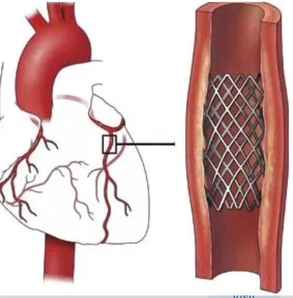 Инфаркт миокарда стентирование. Инфаркт миокарда операция стентирование. Стентирование коронарных артерий схема. Стентирование коронарных сосудов. Стентирование сосудов последствия