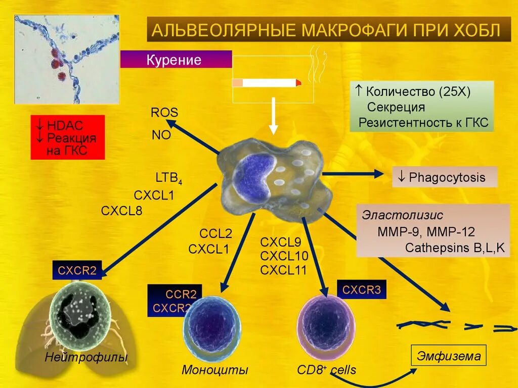 Альвеолярные макрофаги курильщика. Альвеолярные макрофаги с миелином. Альвеолярные макрофаги клетки курильщика. Макрофаги легких.