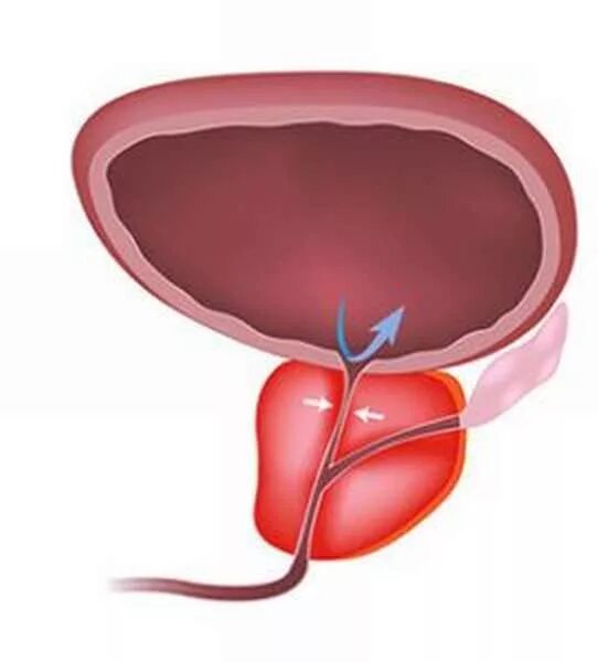 Простата. Уретра у мужчин инфекция
