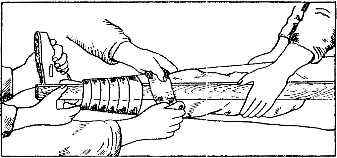 Перелом голени транспортировка. Наложение шины при переломе. Перелом костей голени первая помощь.