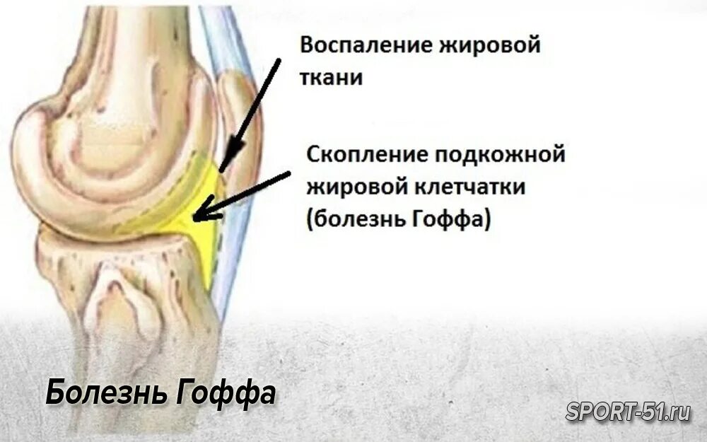 Отек гоффа коленного сустава. Болезнь жирового тела Гоффа. Тело Гоффа коленного сустава. Импиджмент клетчатки Гоффа.