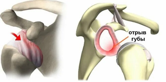 Губа гленоида плечевого сустава. Фиброзно-хрящевая губа гленоида. Фиброзно-хрящевая губа гленоида плечевого сустава. Разрыв гленоида плечевого.