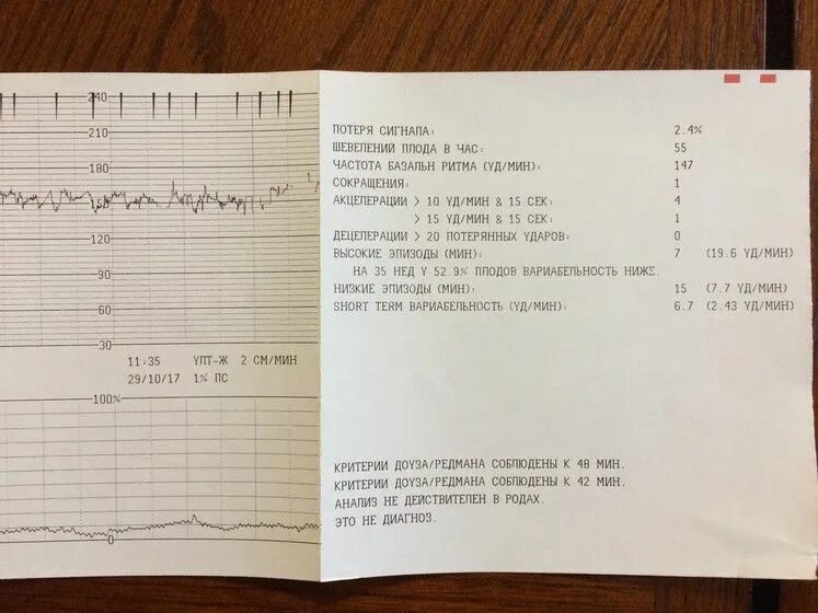 КТГ по критериям Доуза-Редмана. Критерии Доуза Редмана КТГ. Шевеления плода на КТГ. Норма шевелений на КТГ. Как ощущаются шевеления плода