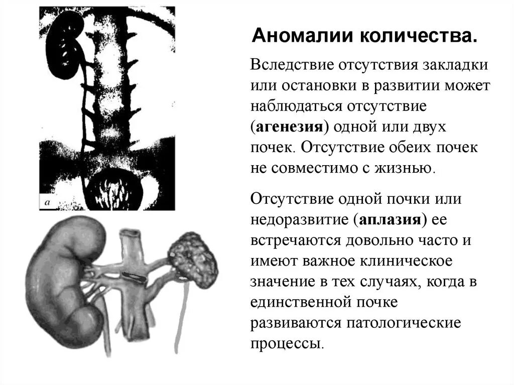 За сколько проходят почки. Врожденная аплазия почки. Аномалии почек агенезия. Агенезия и аплазия почки.