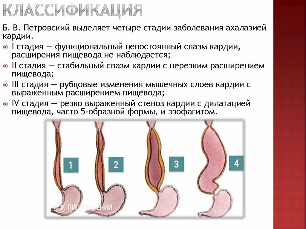 Ахалазия пищевода эндоскопическая классификация. Рентгенологическая классификация ахалазии пищевода. Ахалазия пищевода 1 ст рентген. Ахалазия пищевода 2 стадия. Халазия пищевода