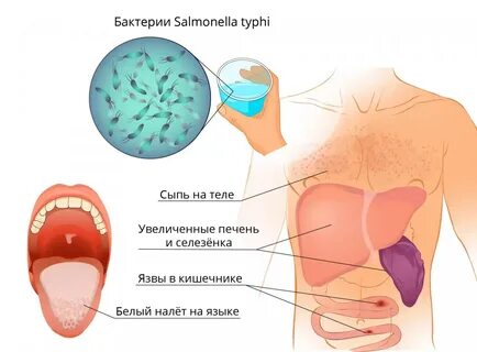 Брюшной тиф дифтерия