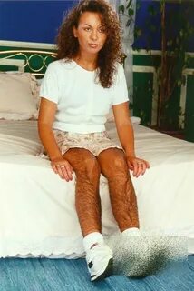 Hirsute Sandra is the world's most hairy model who was active in the 1...