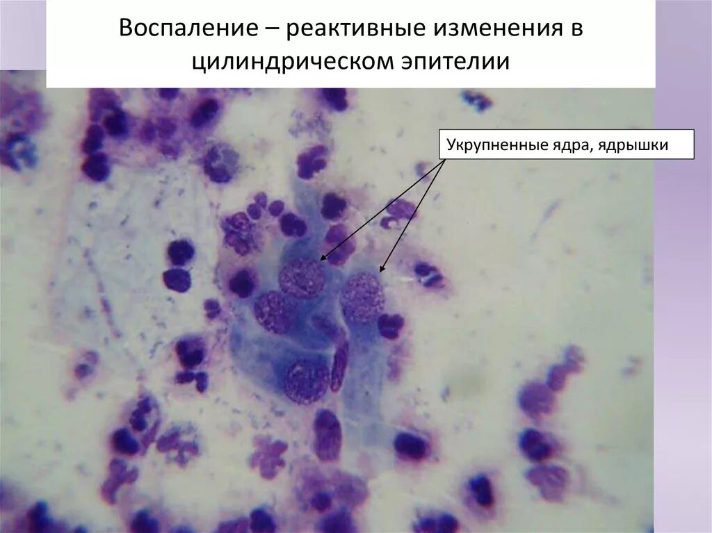 Клетки с признаками реактивных изменений