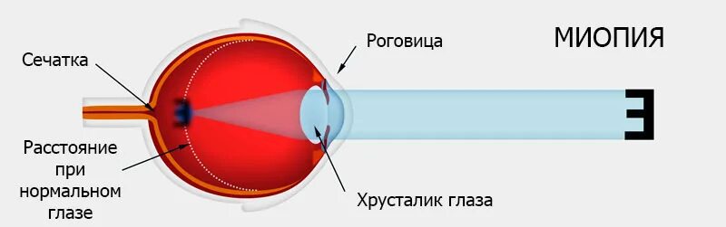 Слабая миопия глаза что. Миопия 2 степени. Миопия 2 степени обоих глаз что это. Миопия 2.75. Зрение миопия слабой степени.