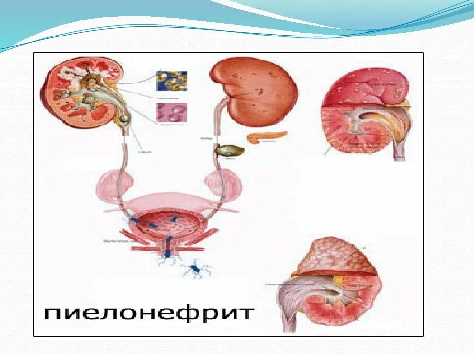 Пиелонефрит педиатрия. Клинические проявления пиелонефрита у детей. Пиелонефрит презентация.