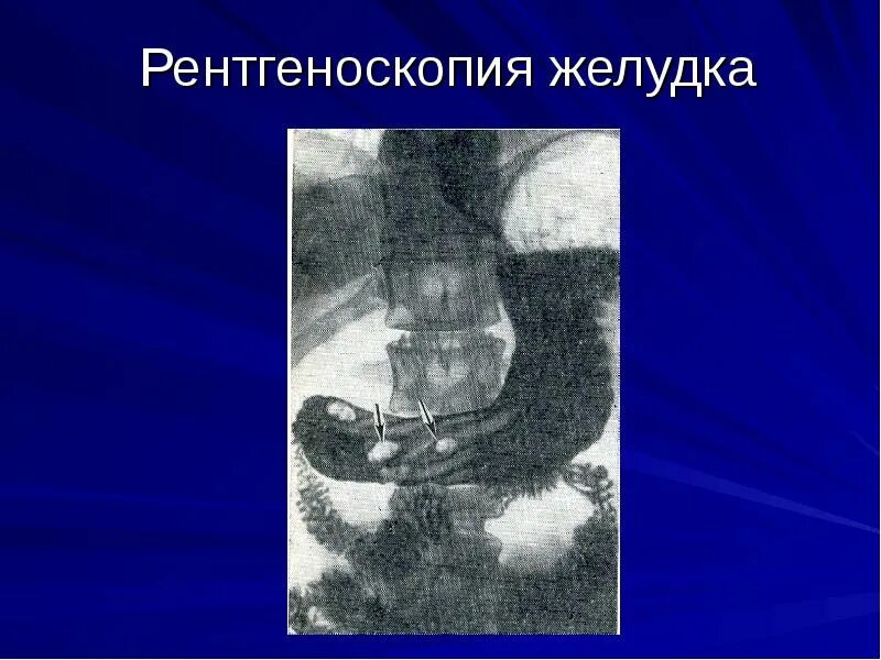 Рентген желудка что это. Контрастирование 12 перстной кишки рентген. Рентген желудка что это. Рентген желудка что это. Рентген пищеварительного тракта.