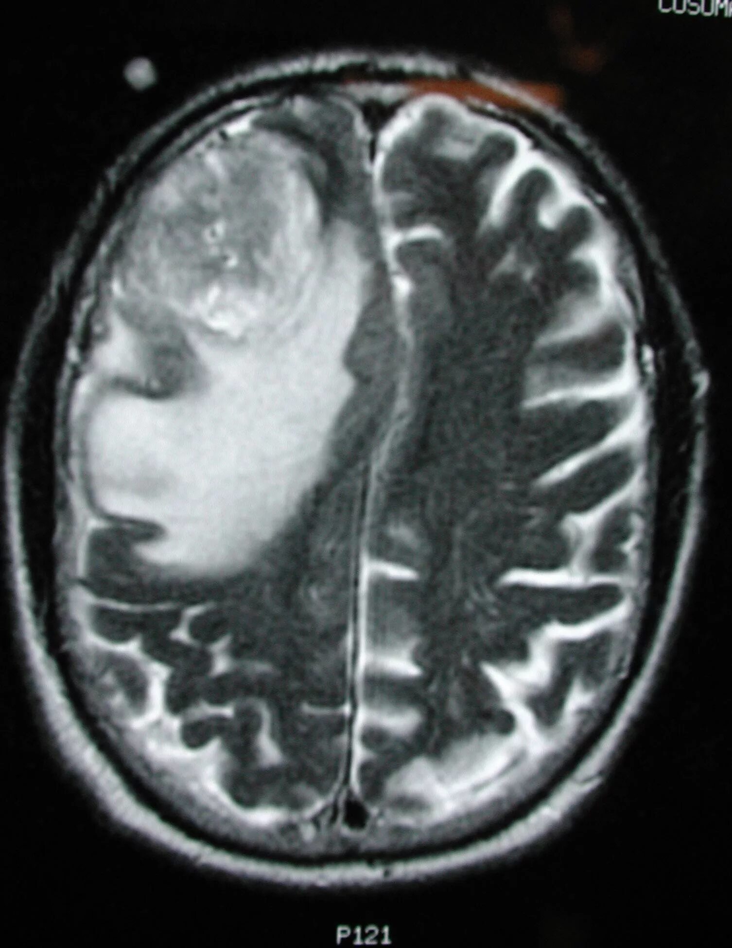 Мультиформная глиобластома мрт. Опухоль головного мозга глиобластома 4. Глиобластома клинические проявления. Глиобластома 4 стадии неоперабельная. Мультиформная глиобластома.
