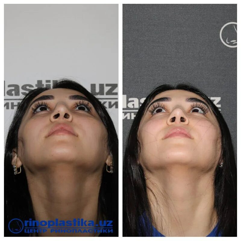 центр ринопластики. центр ринопластики. ринопластика киров. ринопластика константинов бадри. центр ринопластики.