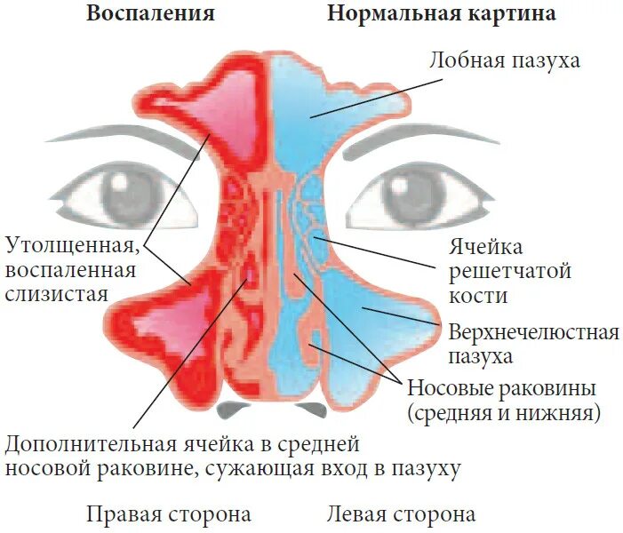 Локальное утолщение слизистой. Околоносовые пазухи и соустья. Соустье гайморовой пазухи. Ячейки решетчатого Лабиринта.